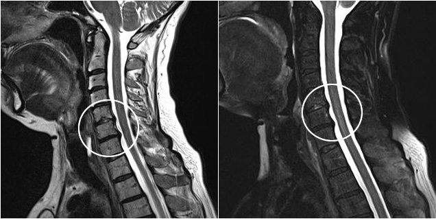 osteocondrose cervical na imagem de ressonância magnética