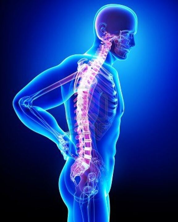 Coluna humana afetada pela osteocondrose